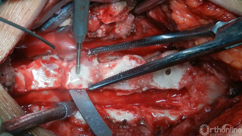 手术视频详解:颈后路单开门椎管扩大成形术