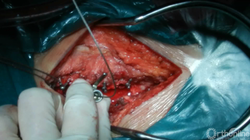 手术视频详解:颈后路单开门椎管扩大成形术 