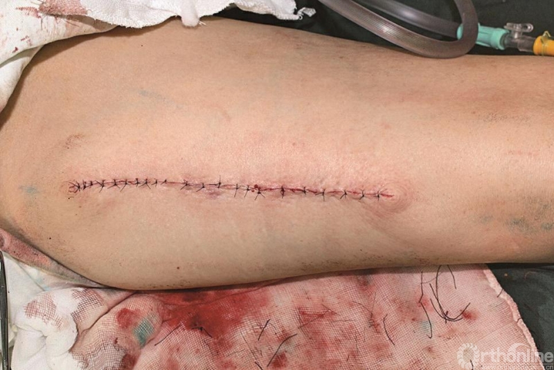 骨折手术后疤痕图片图片