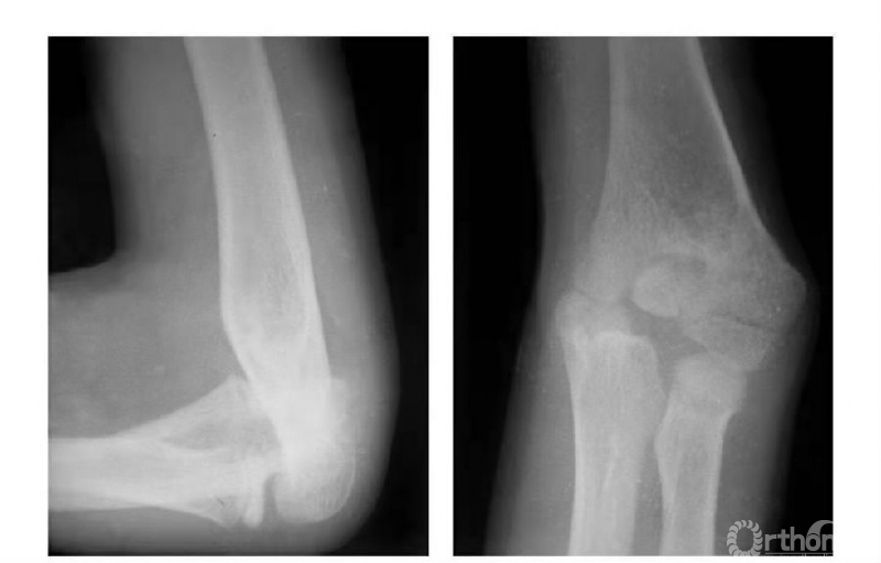骨科常见疾病x线解析之肱骨内髁骨折