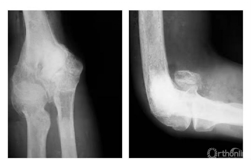 骨科常見疾病x線解析之肱骨內髁骨折