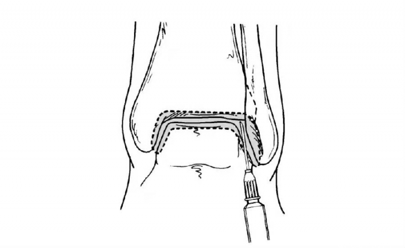 踝关节前外侧穿刺前内侧穿刺点为胫前肌腱与内踝之间刺入;前外侧穿刺