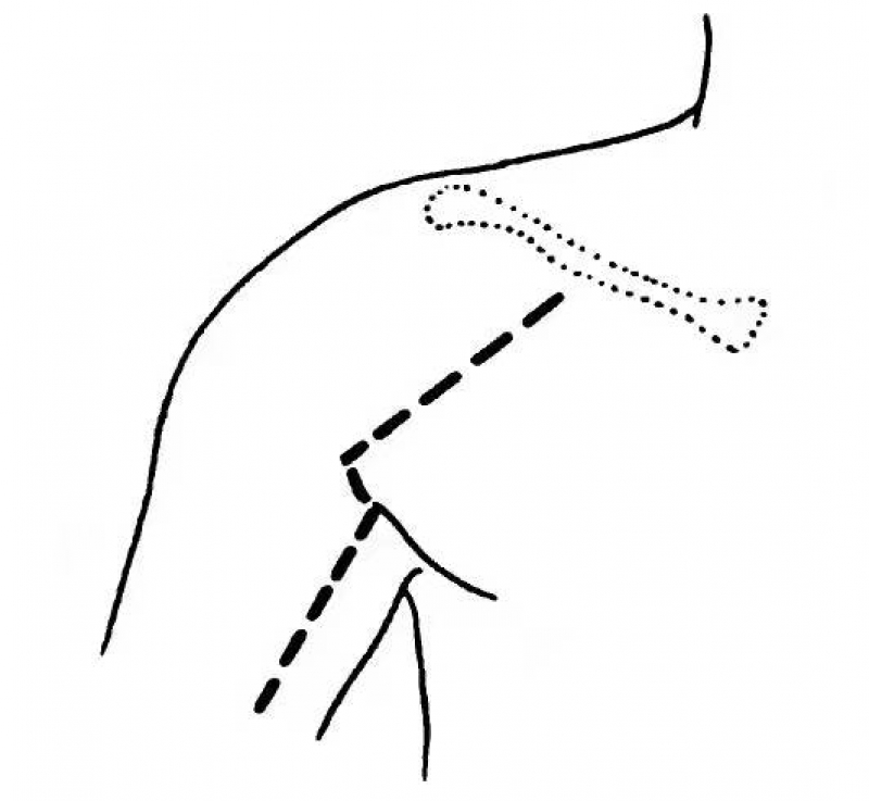 切口從三角肌後下緣的遠1/3開始,向外下伸延,沿三角肌後下緣,經過肱三