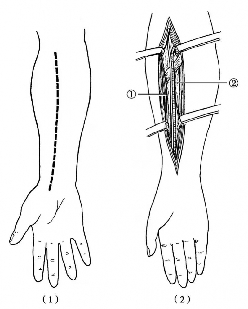 神經顯露的手術切口及步驟之橈神經