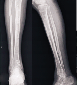 腿骨折的x光照片图片