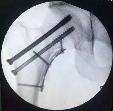空心钉固定股骨颈骨折,我们错了吗?