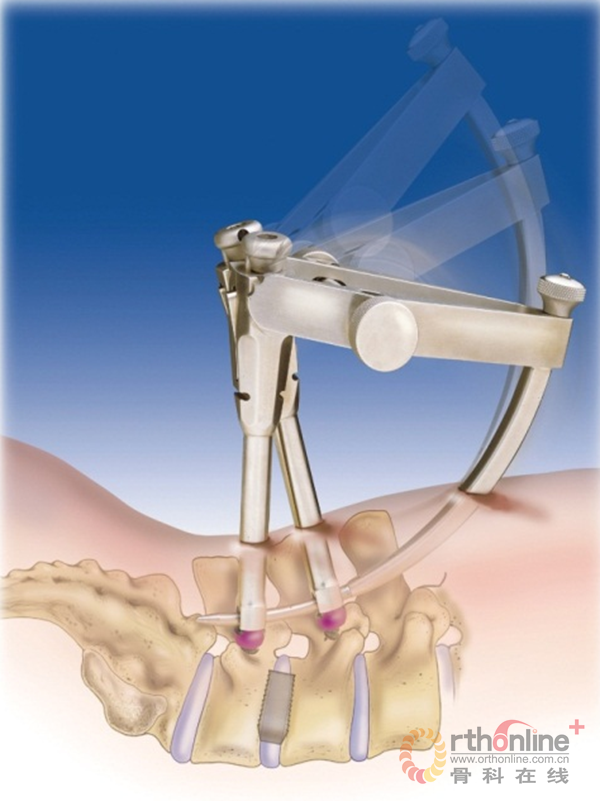 椎弓根螺钉技术图片