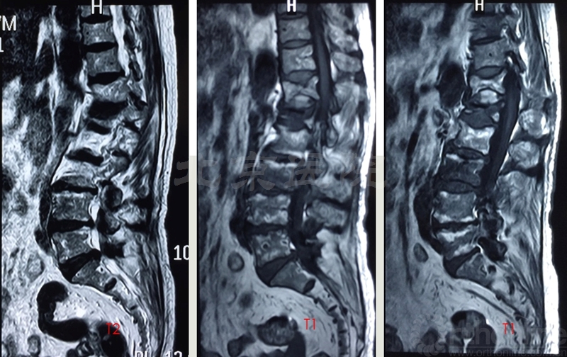 胸腰段後凸畸形退行性脊柱側彎腰椎管狹窄症:l45s1腰3椎體壓縮性骨折