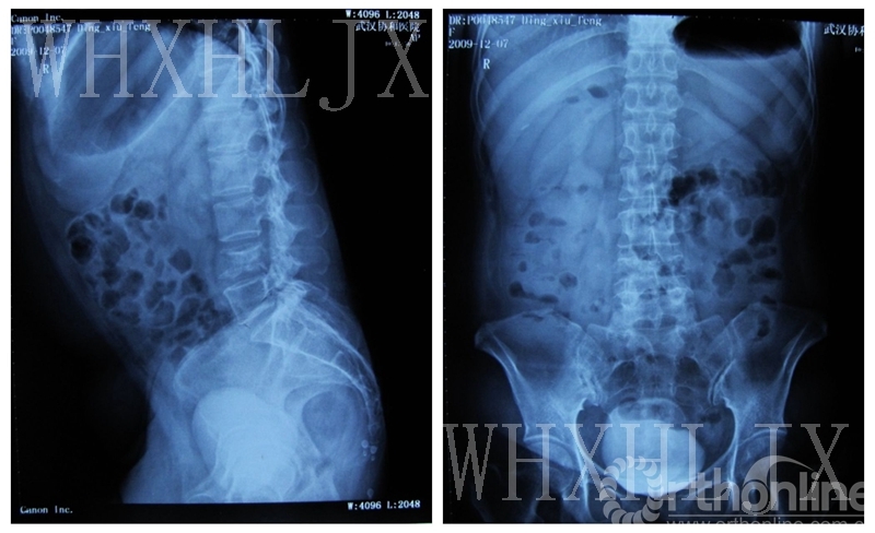 脊柱转移瘤胸椎图片