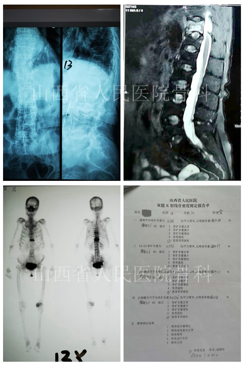 重度骨質疏鬆性椎體壓縮性骨折容易被忽視的問題