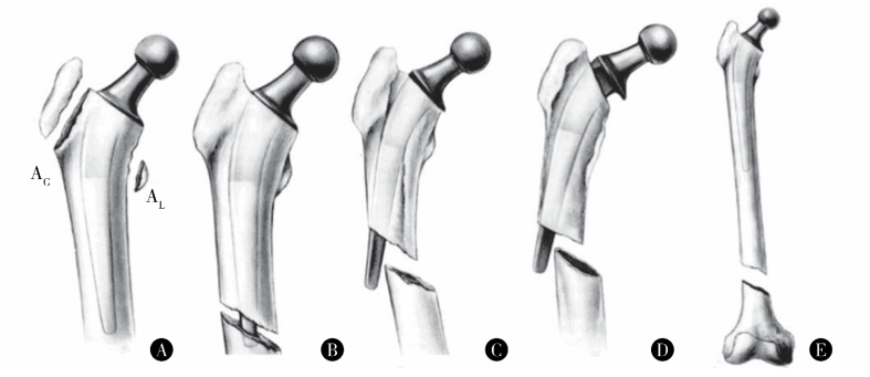 常用的股骨假体周围骨折的分型方法包括温哥华分型(vancouver classif