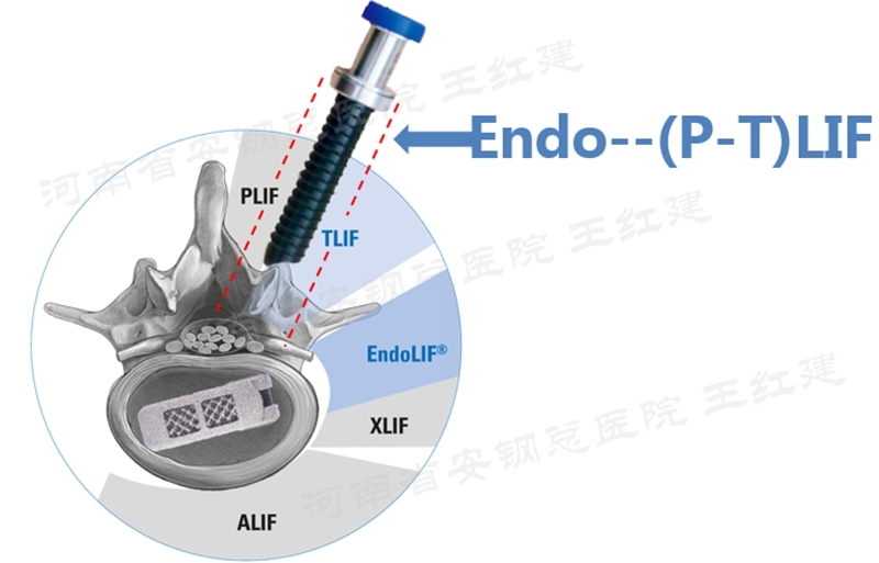 endo