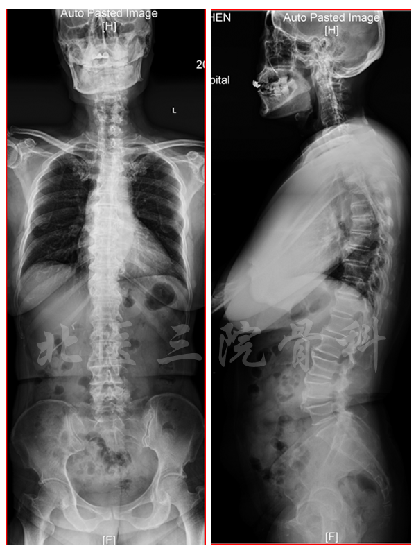 手术视频详解胸椎管狭窄症治疗的北医三院骨科经验