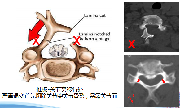 手术视频详解:颈后路单开门椎管扩大成形术