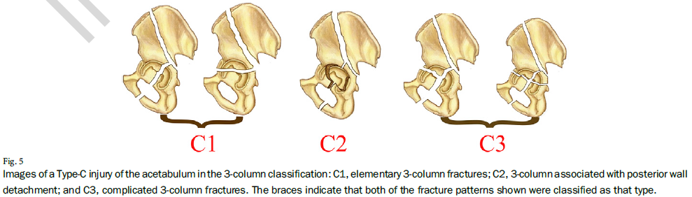 髋臼骨折的三柱分型