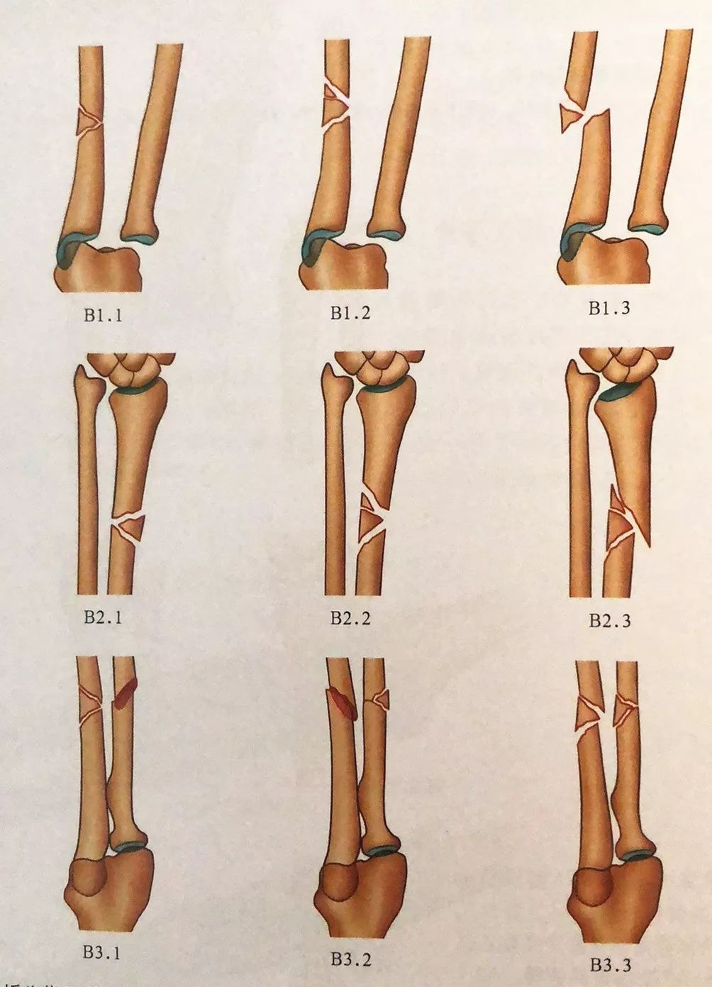 肱骨干骨折分类图片