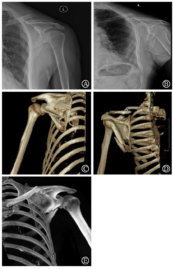 图17 术前x线片及ct三维重建示肩胛骨骨折累及肩胛颈及肩胛骨体部图a