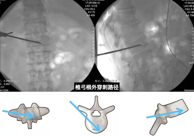 胸椎的單側穿刺雙側彌散入路