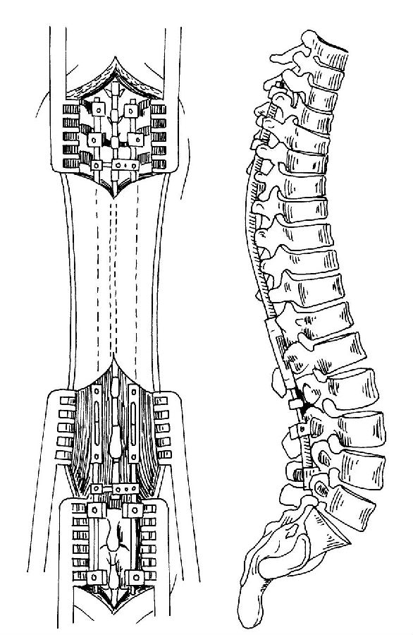 特发性脊柱侧凸的治疗原则之:婴儿型及少儿型脊柱侧凸