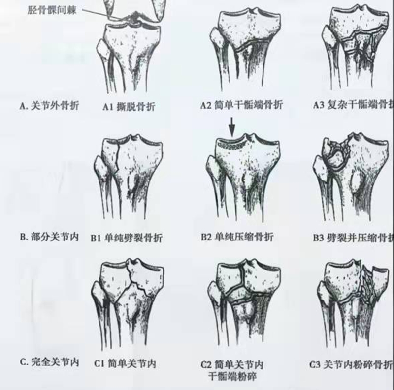 骨折的分类和分型图片图片