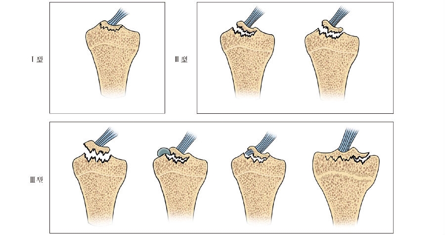 胫骨髁间棘骨折(tibial spine avulsion fractures, tsafs)是一种特殊